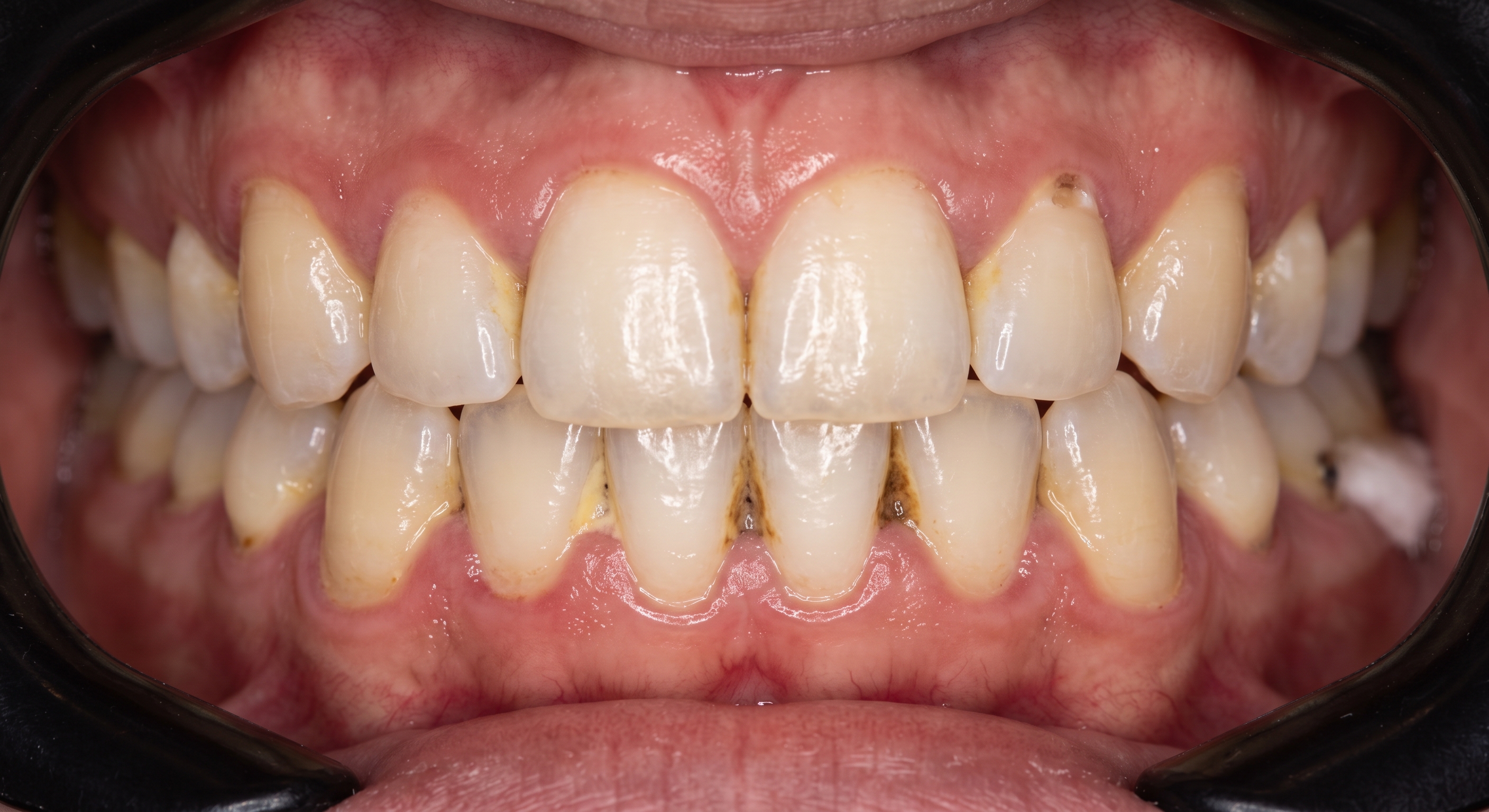 Kondisi Gigi Pasien Sebelum Perawatan di DentalHouse Padang